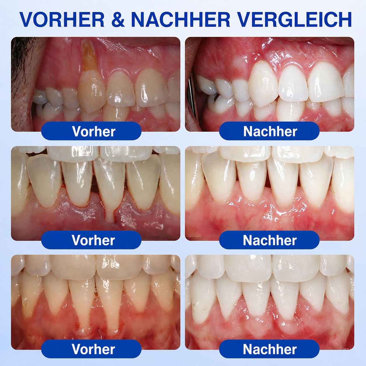 [Noch 5 Minuten!] Healrize® GumRevive Gel zur Regeneration des Zahnhalteapparats