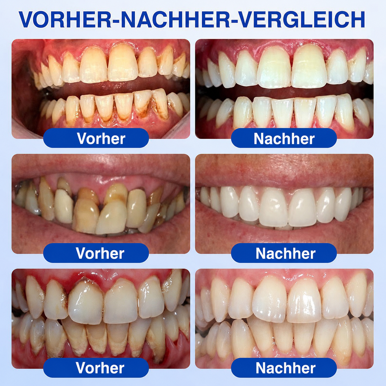 [Noch 5 Minuten!] Healrize® GumRevive Gel zur Regeneration des Zahnhalteapparats